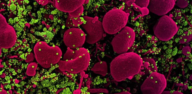 Colorized scanning electron micrograph of an apoptotic cell (pink) heavily infected with SARS-COV-2 virus particles (green), isolated from a patient sample.